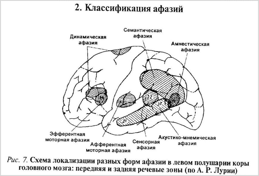 Изображение к статье: Афазия - симптомы, причины, диагностика и лечение