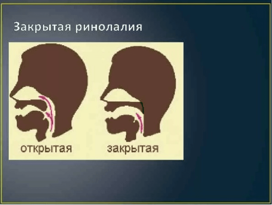 Изображение по разделу: Характерные особенности ринолалии