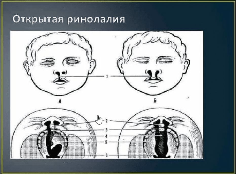 Изображение по разделу: Характерные особенности ринолалии