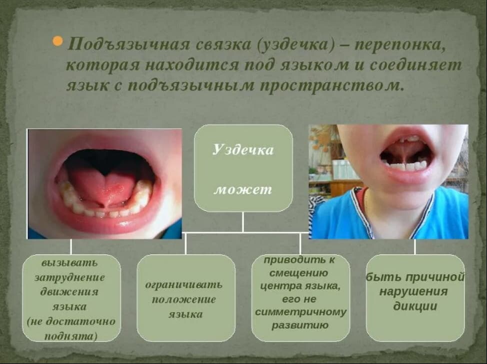Изображение к статье: Логопед после подрезания уздечки у ребенка