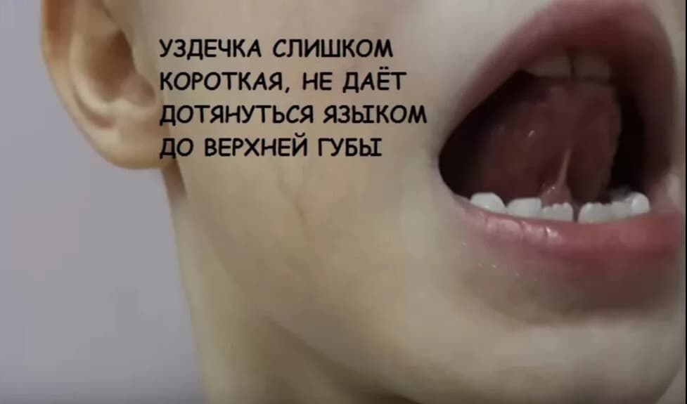 Изображение к статье: Логопед после подрезания уздечки у ребенка