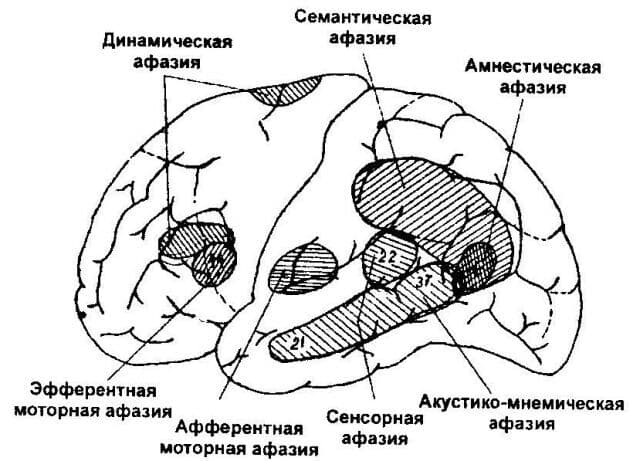 Изображение к статье: Нарушения речи при поражении корковых отделов мозга