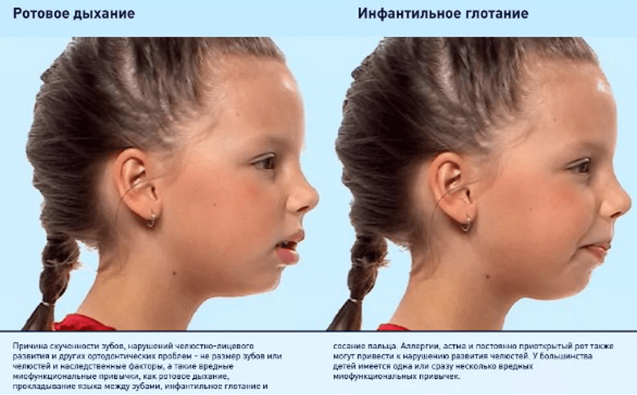 Изображение по разделу: Симптомы инфантильного глотания