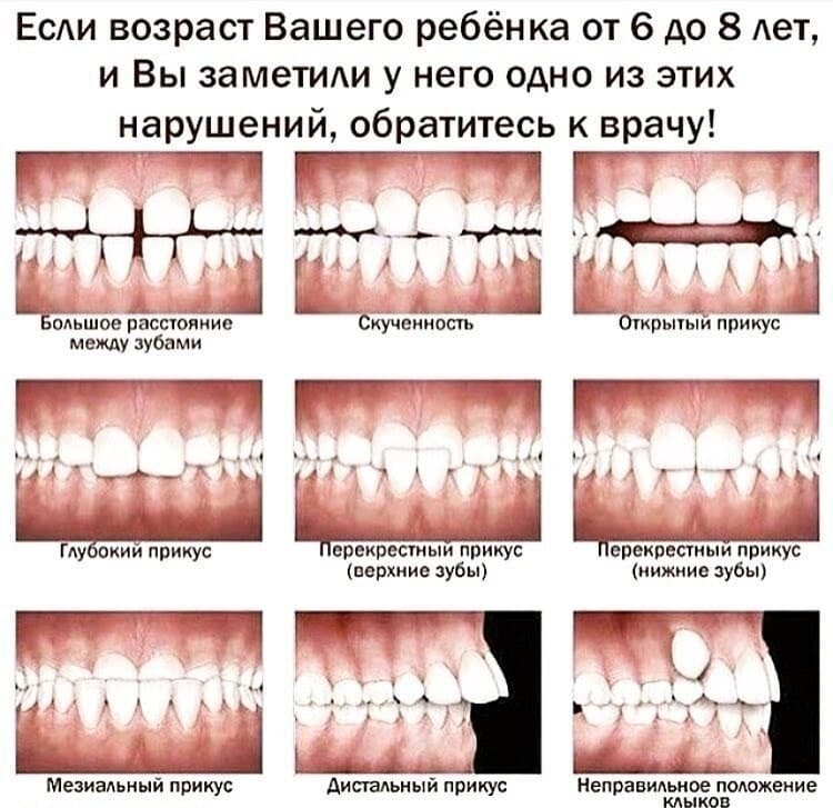 Изображение к статье: Связь неправильного прикуса и дефектов произношения у детей
