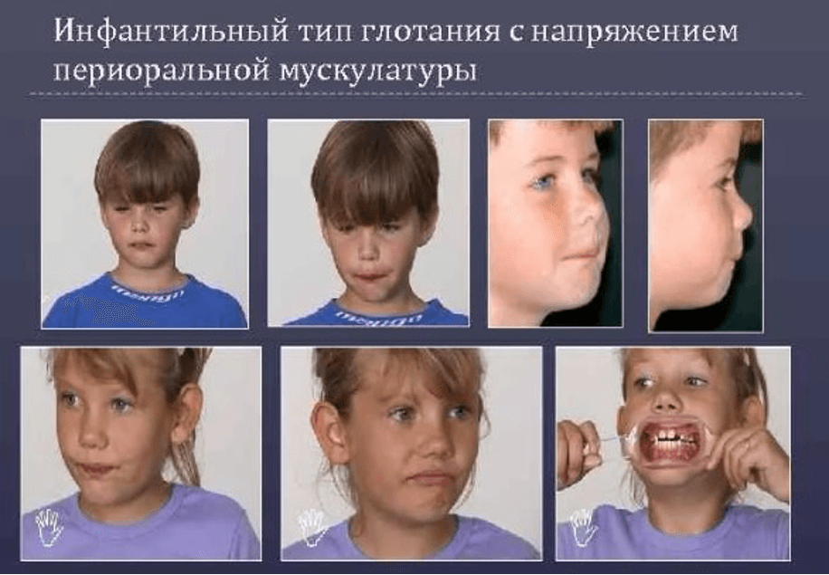 Изображение по разделу: Упражнения для коррекции инфантильного глотания